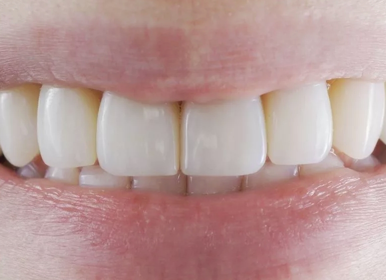 Цена композитной реставрации. Восстановление передних зубов. Реставрированные передние зубы. Восстановление зубов композитными материалами. Передние композитные зубы.